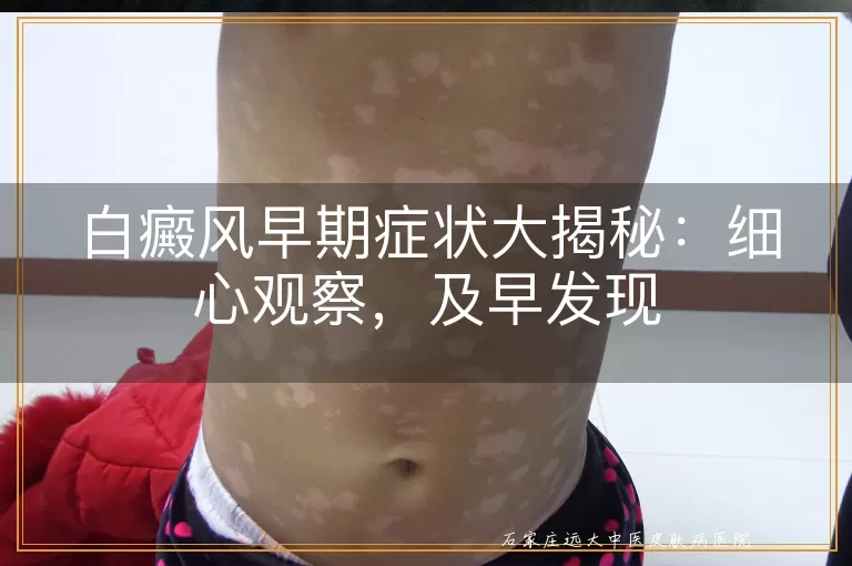 白癜风早期症状大揭秘：细心观察，及早发现