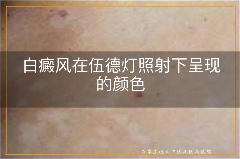 白癜风在伍德灯照射下呈现的颜色