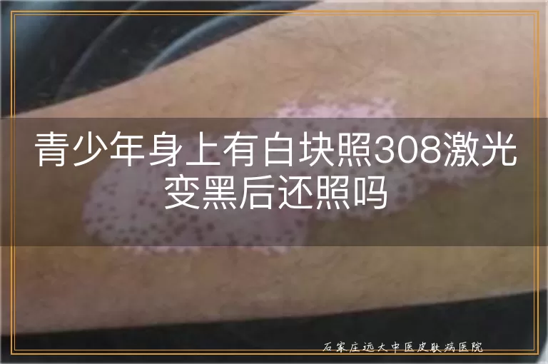 青少年身上有白块照308激光变黑后还照吗