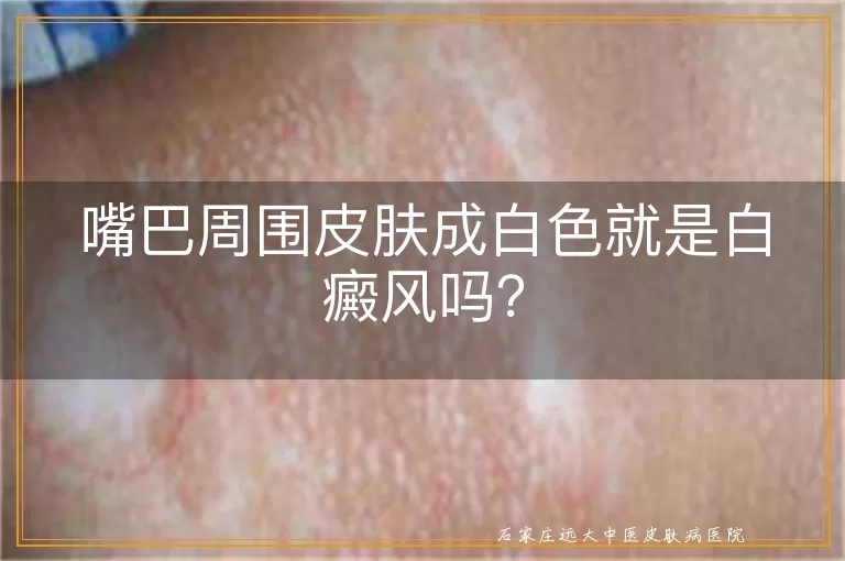 嘴巴周围皮肤成白色就是白癜风吗?