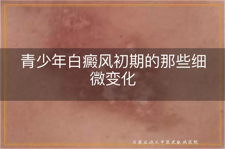 青少年白癜风初期的那些细微变化