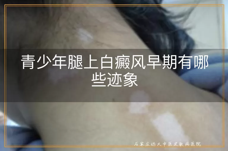 青少年腿上白癜风早期有哪些迹象