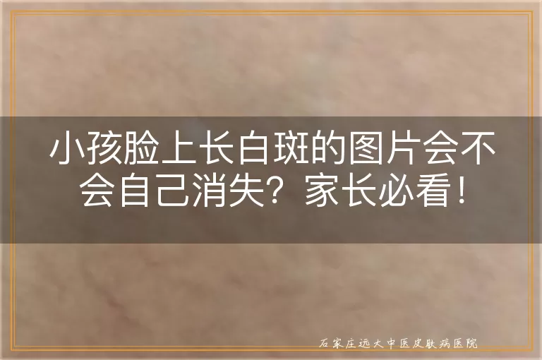 小孩脸上长白斑的图片会不会自己消失？家长必看！