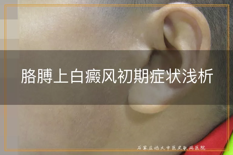 胳膊上白癜风初期症状浅析