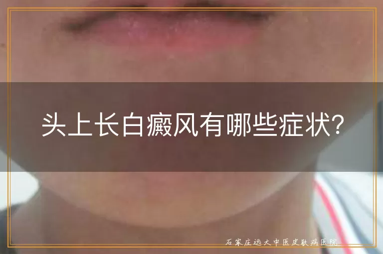 头上长白癜风有哪些症状？