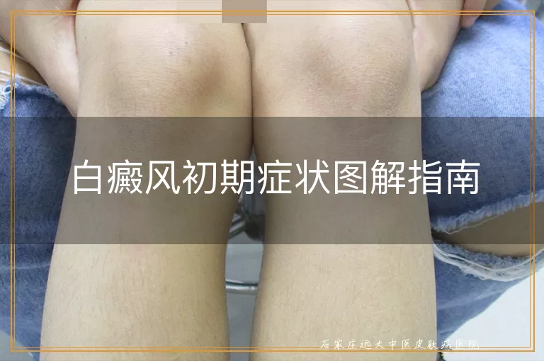 白癜风初期症状图解指南