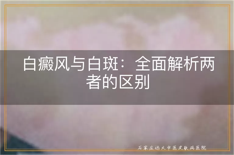 白癜风与白斑：全面解析两者的区别