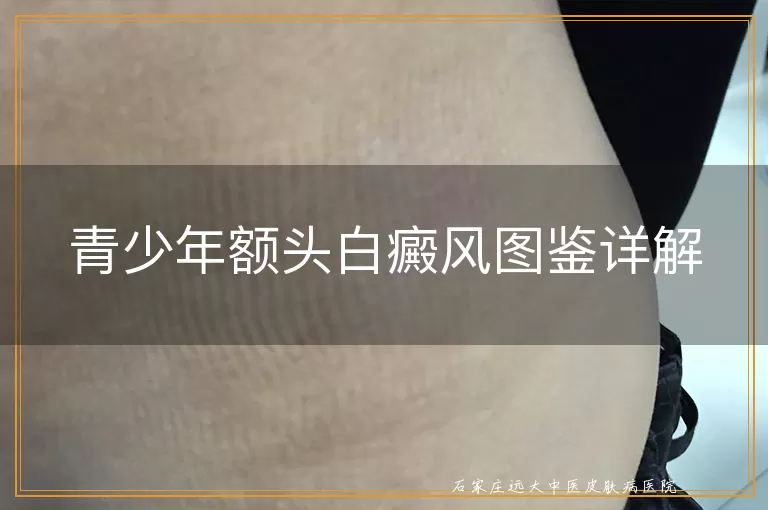 青少年额头白癜风图鉴详解