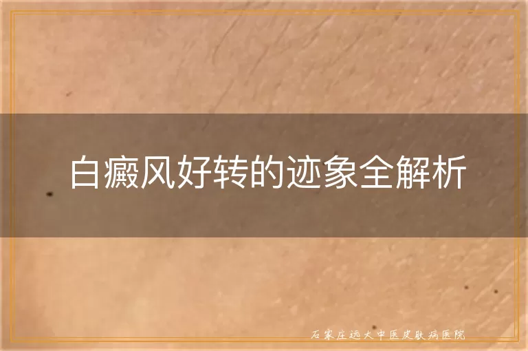 白癜风好转的迹象全解析