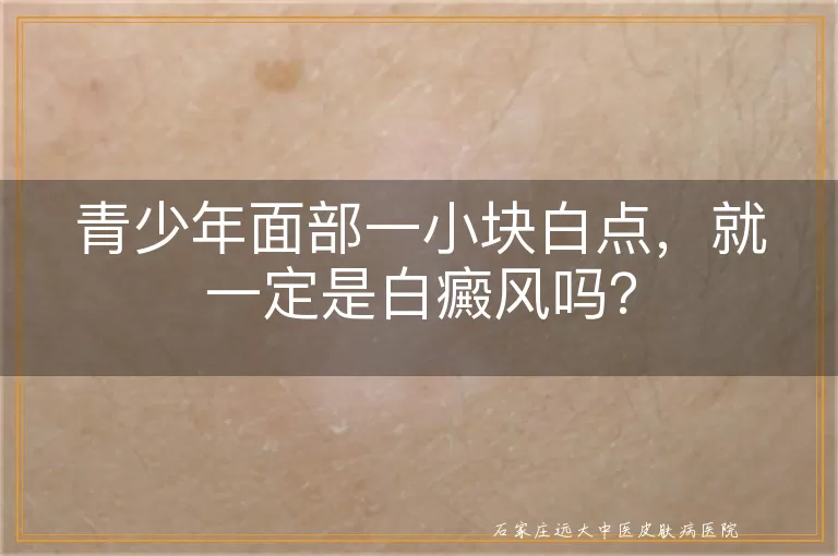 青少年面部一小块白点,就一定是白癜风吗?