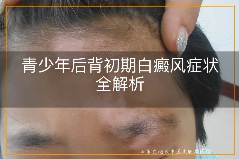 青少年后背初期白癜风症状全解析