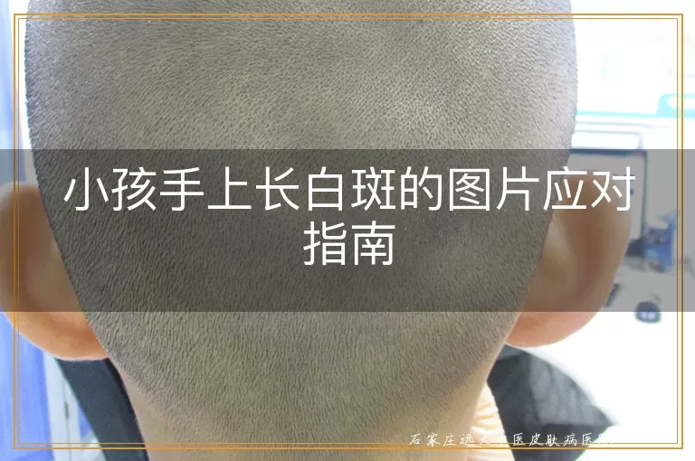 小孩手上长白斑的图片应对指南