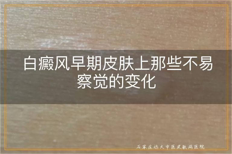 白癜风早期皮肤上那些不易察觉的变化