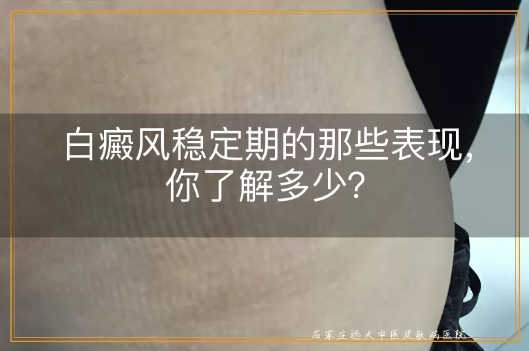 白癜风稳定期的那些表现，你了解多少？