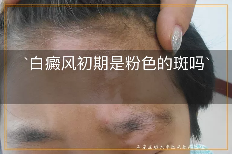 白癜风初期是粉色的斑吗