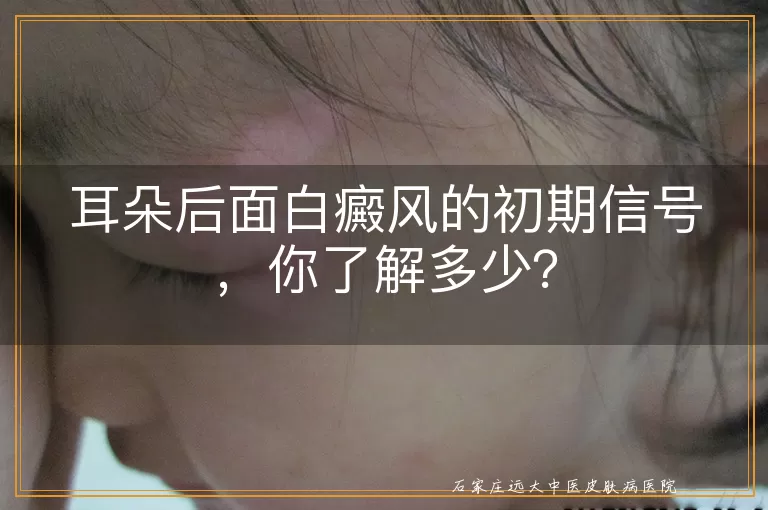 耳朵后面白癜风的初期信号，你了解多少？
