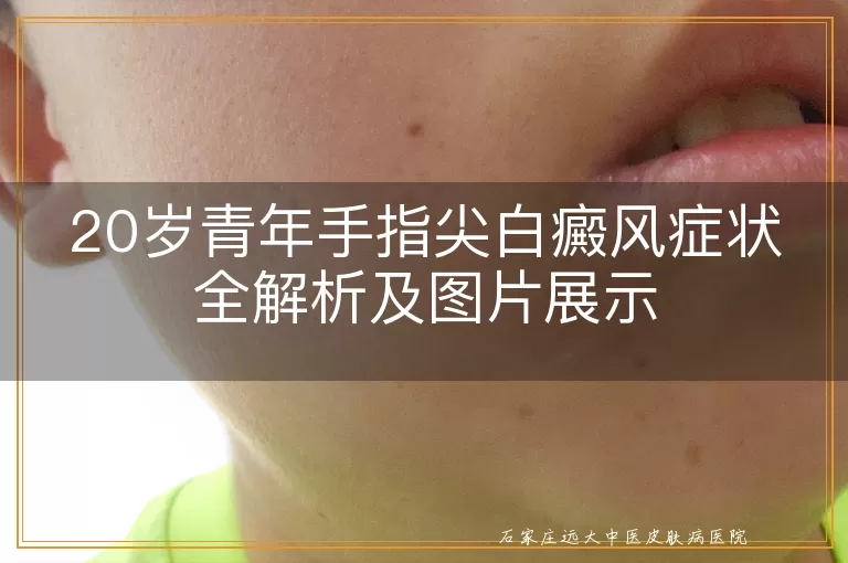 20岁青年手指尖白癜风症状全解析及图片展示