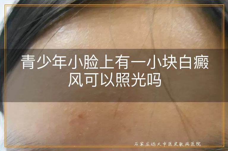 青少年小脸上有一小块白癜风可以照光吗