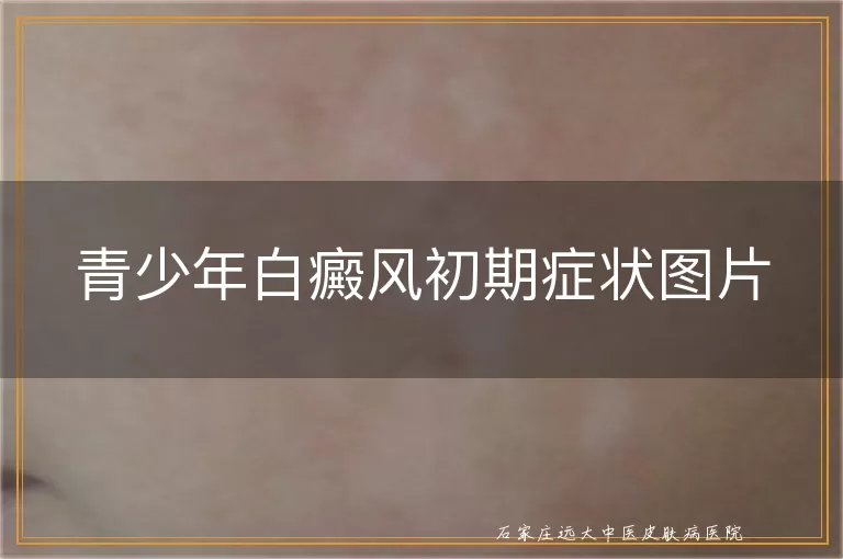 青少年白癜风初期症状图片
