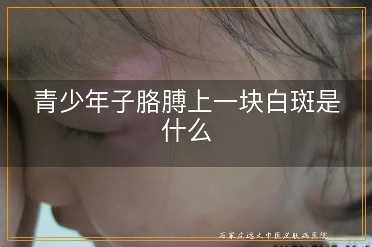 青少年子胳膊上一块白斑是什么