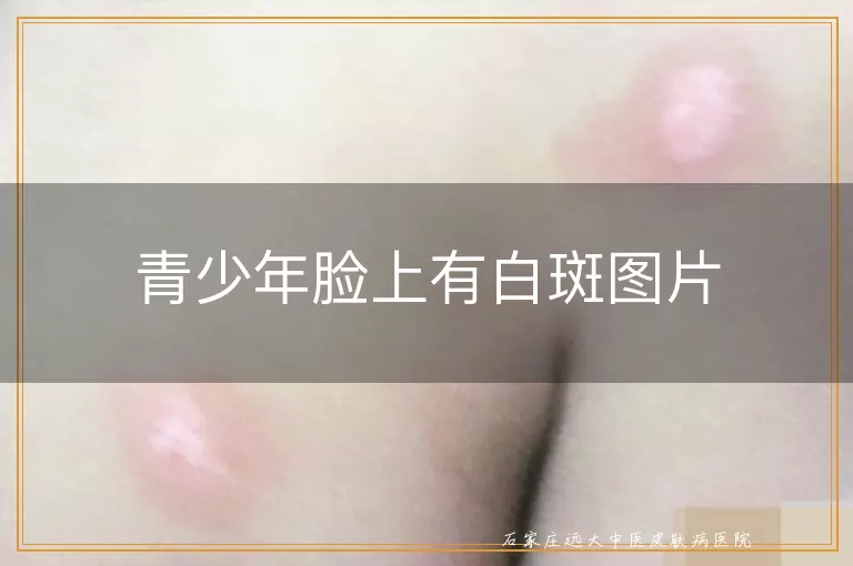 青少年脸上有白斑图片