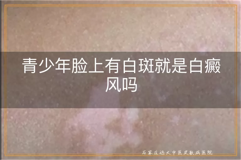 青少年脸上有白斑就是白癜风吗