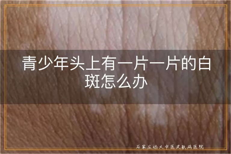 青少年头上有一片一片的白斑怎么办