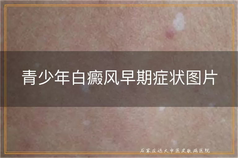 青少年白癜风早期症状图片