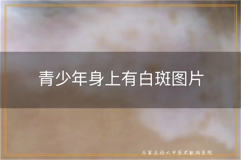 青少年身上有白斑图片