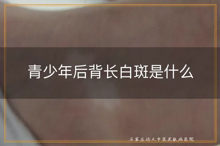 青少年后背长白斑是什么