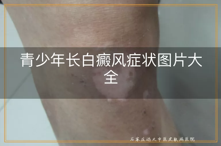 青少年长白癜风症状图片大全