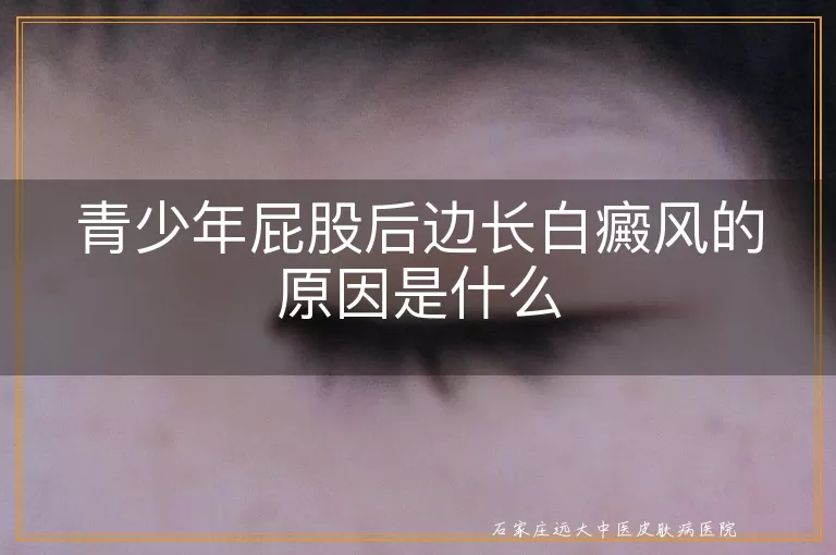 青少年屁股后边长白癜风的原因是什么