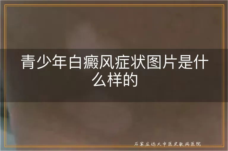 青少年白癜风症状图片是什么样的
