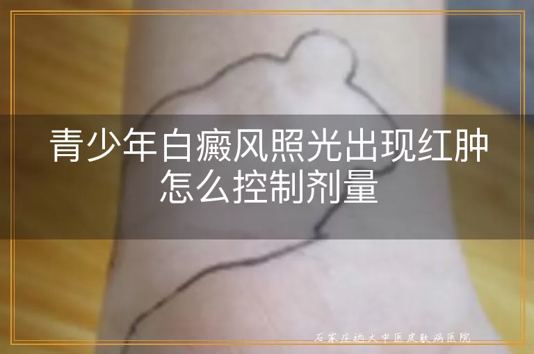 青少年白癜风照光出现红肿怎么控制剂量