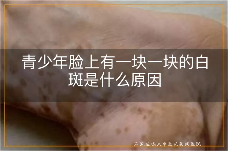 青少年脸上有一块一块的白斑是什么原因