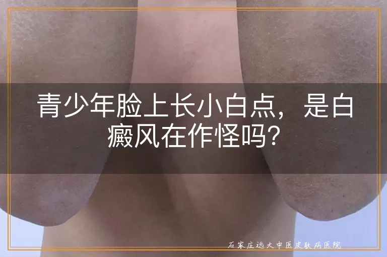 青少年脸上长小白点，是白癜风在作怪吗？