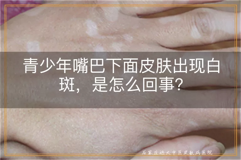 青少年嘴巴下面皮肤出现白斑，是怎么回事？