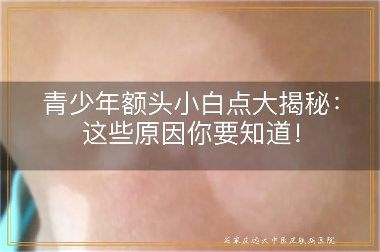 青少年额头小白点大揭秘:这些原因你要知道!