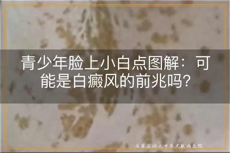 青少年脸上小白点图解：可能是白癜风的前兆吗？