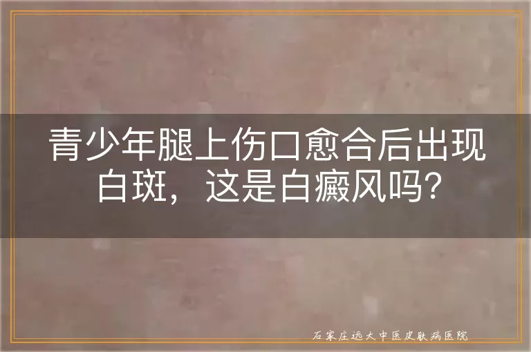 青少年腿上伤口愈合后出现白斑，这是白癜风吗？