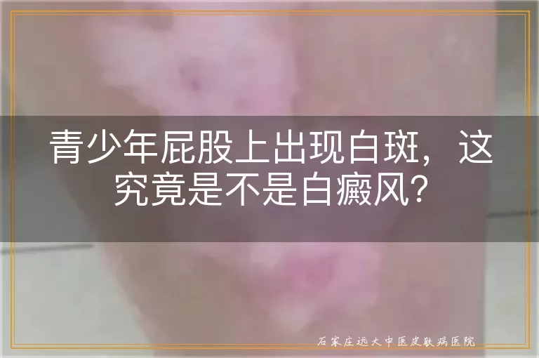 青少年屁股上出现白斑，这究竟是不是白癜风？