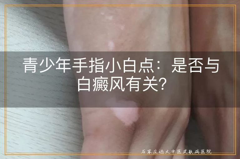 青少年手指小白点：是否与白癜风有关？