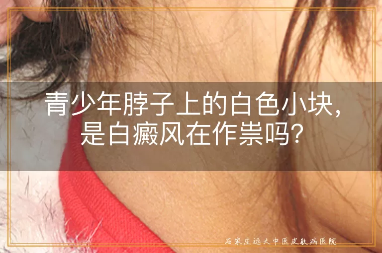 青少年脖子上的白色小块，是白癜风在作祟吗？