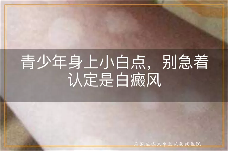 青少年身上小白点，别急着认定是白癜风