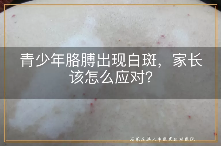 青少年胳膊出现白斑，家长该怎么应对？