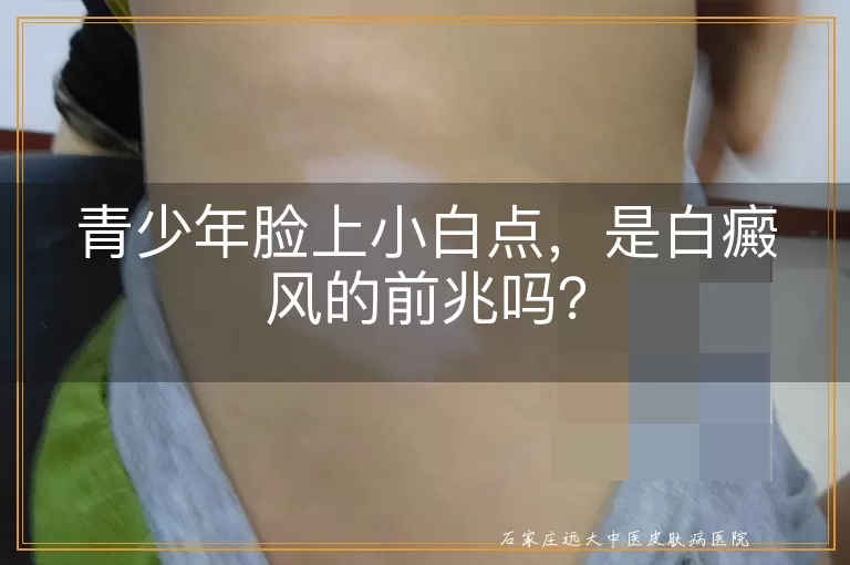 青少年脸上小白点，是白癜风的前兆吗？