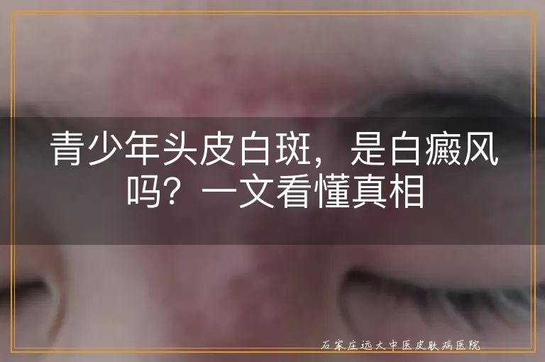 青少年头皮白斑,是白癜风吗?一文看懂真相