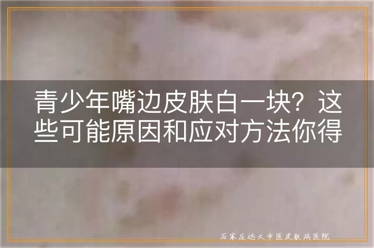青少年嘴边皮肤白一块？这些可能原因和应对方法你得知道