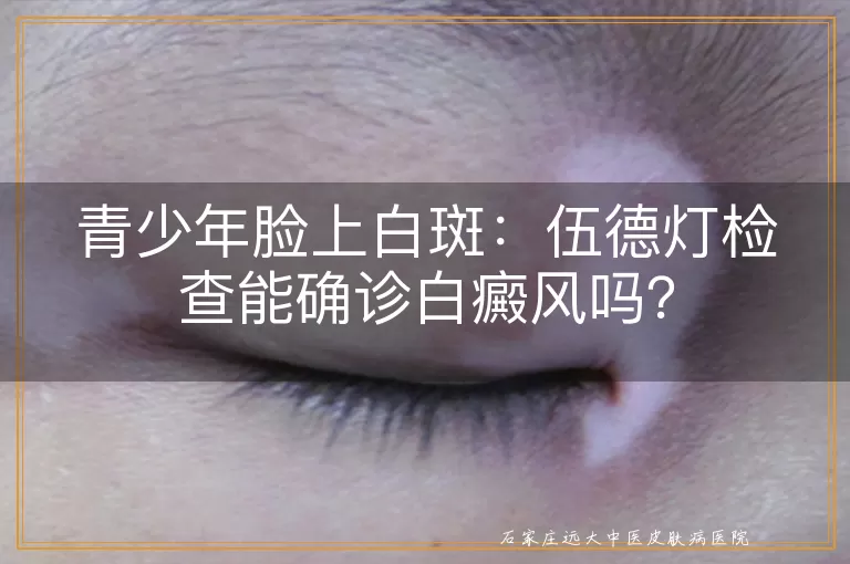青少年脸上白斑：伍德灯检查能确诊白癜风吗？