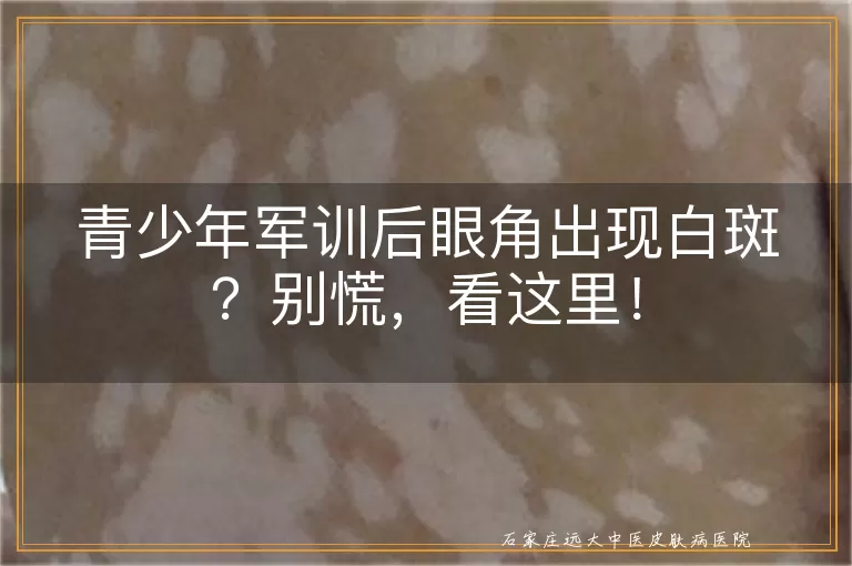 青少年军训后眼角出现白斑？别慌，看这里！